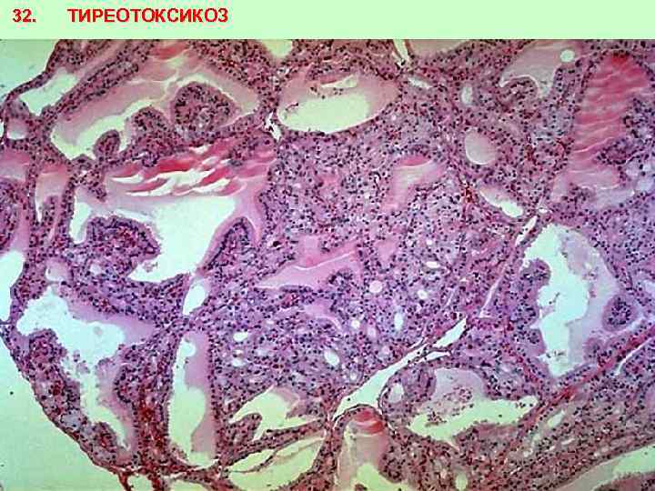 32. ТИРЕОТОКСИКОЗ 
