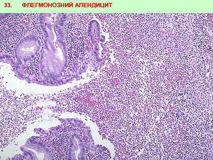 33. ФЛЕГМОНОЗНИЙ АПЕНДИЦИТ 