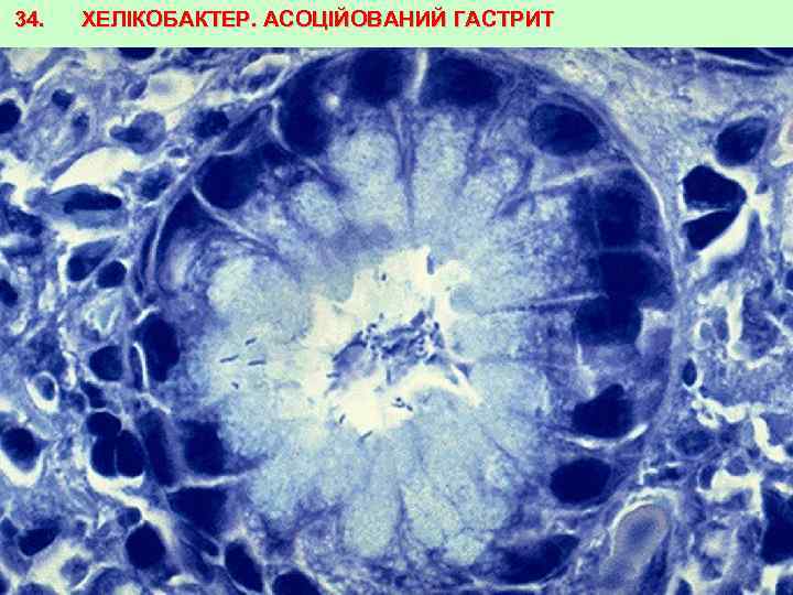 34. ХЕЛІКОБАКТЕР. АСОЦІЙОВАНИЙ ГАСТРИТ 