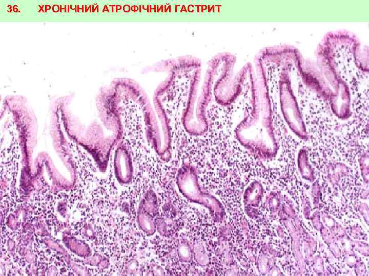 36. ХРОНІЧНИЙ АТРОФІЧНИЙ ГАСТРИТ 