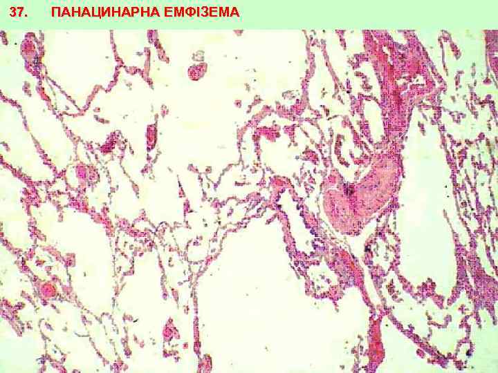 37. ПАНАЦИНАРНА ЕМФІЗЕМА 