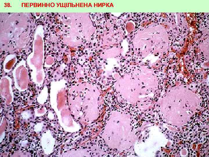 38. ПЕРВИННО УЩІЛЬНЕНА НИРКА 