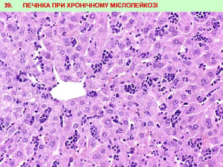 39. ПЕЧІНКА ПРИ ХРОНІЧНОМУ МІЄЛОЛЕЙКОЗІ 