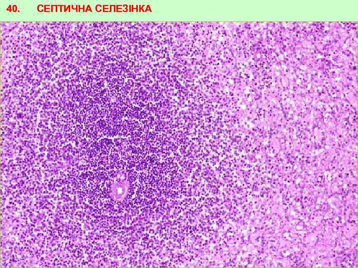 40. СЕПТИЧНА СЕЛЕЗІНКА 