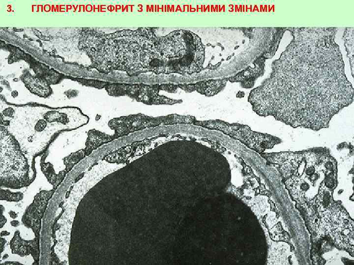 3. ГЛОМЕРУЛОНЕФРИТ З МІНІМАЛЬНИМИ ЗМІНАМИ 