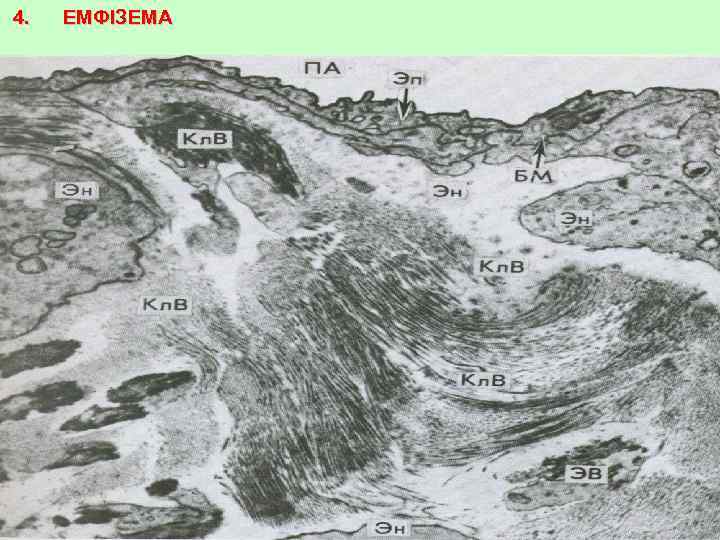 4. ЕМФІЗЕМА 