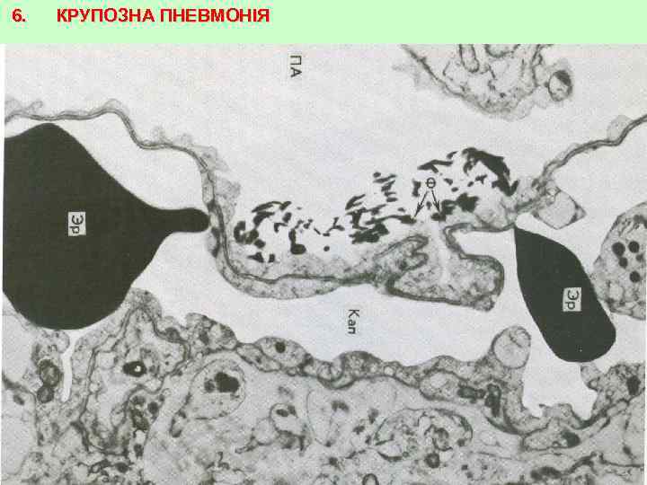 6. КРУПОЗНА ПНЕВМОНІЯ 