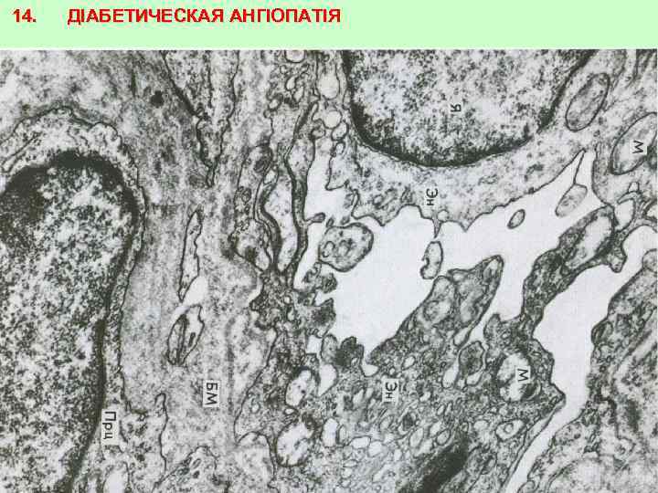 14. ДІАБЕТИЧЕСКАЯ АНГІОПАТІЯ 