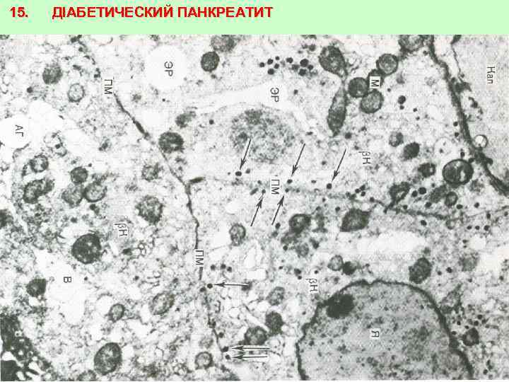 15. ДІАБЕТИЧЕСКИЙ ПАНКРЕАТИТ 