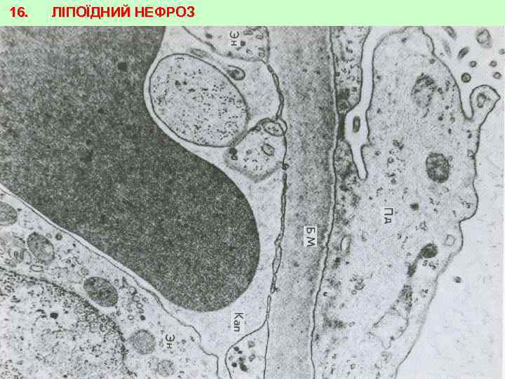 16. ЛІПОЇДНИЙ НЕФРОЗ 