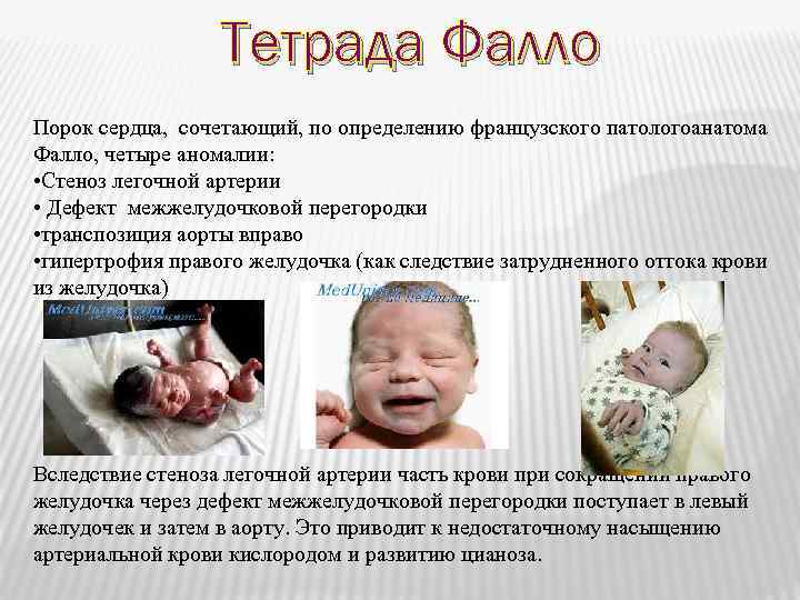 Тетрада Фалло Порок сердца, сочетающий, по определению французского патологоанатома Фалло, четыре аномалии: • Стеноз