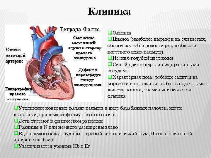 Врожденный порок сердца тетрада фалло презентация