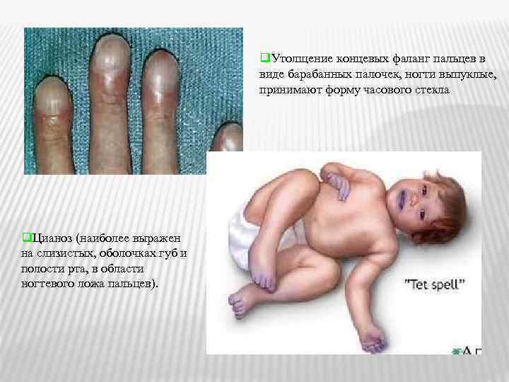 q. Утолщение концевых фаланг пальцев в виде барабанных палочек, ногти выпуклые, принимают форму часового