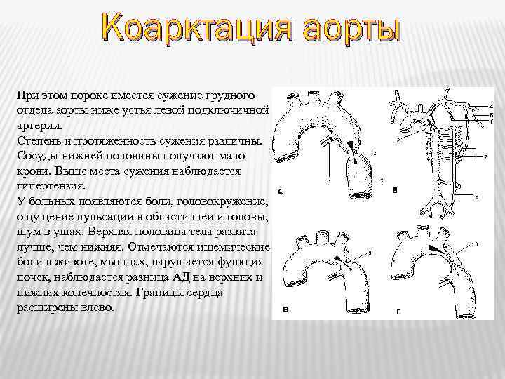 Коарктация аорты При этом пороке имеется сужение грудного отдела аорты ниже устья левой подключичной