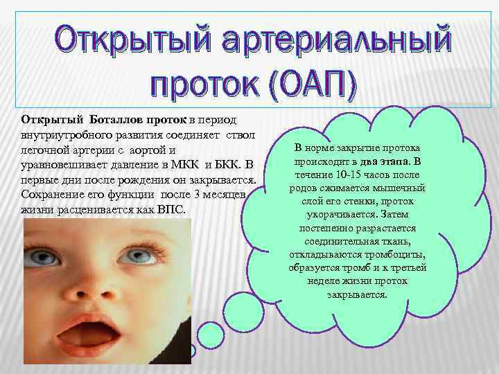 Открытый артериальный проток (ОАП) Открытый Боталлов проток в период внутриутробного развития соединяет ствол легочной