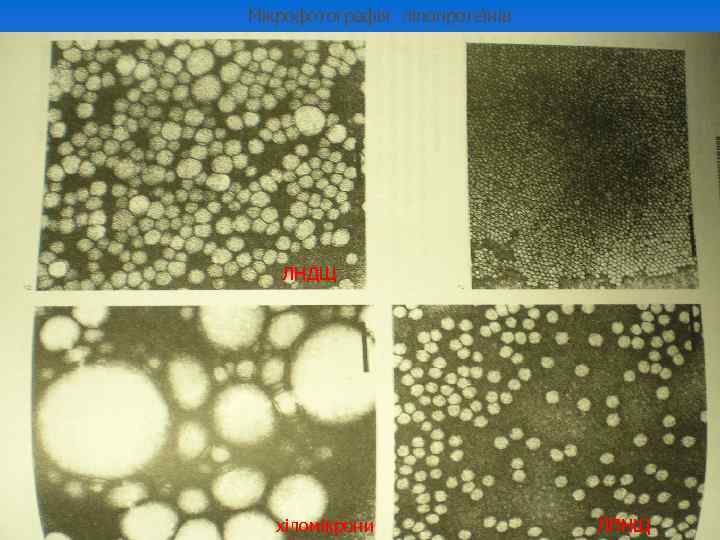 Мікрофотографія ліпопротеїнів ЛНДЩ хіломікрони ЛПНЩ 