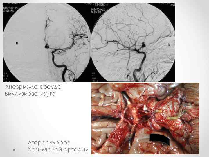 Аневризма сосуда Виллизиева круга Атеросклероз базилярной артерии 