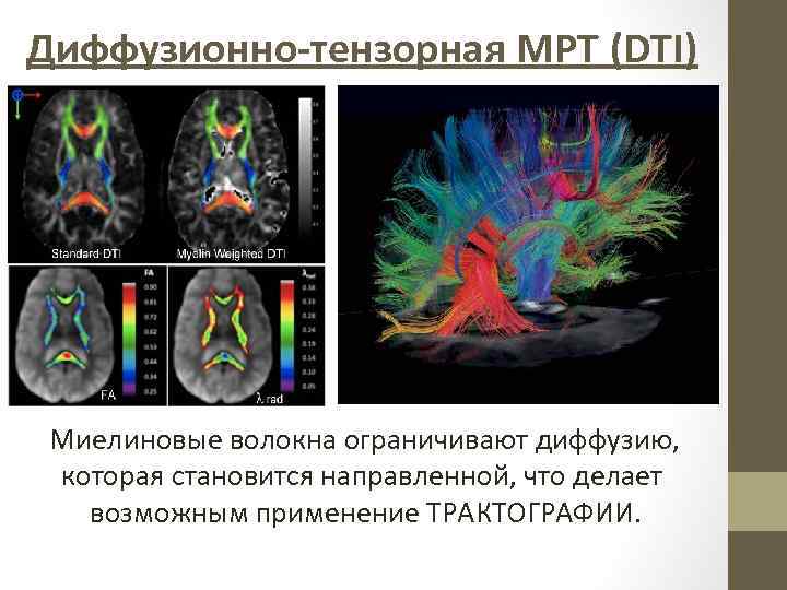 Диффузионно-тензорная МРТ (DTI) Миелиновые волокна ограничивают диффузию, которая становится направленной, что делает возможным применение