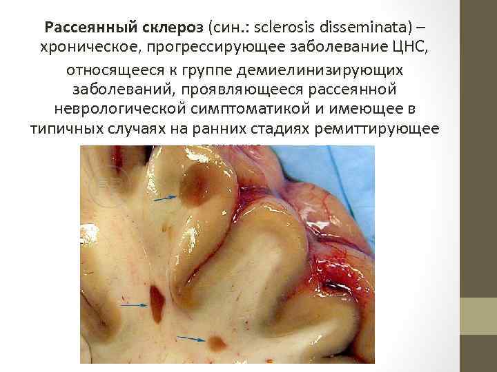 Рассеянный склероз (син. : sclerosis disseminata) – хроническое, прогрессирующее заболевание ЦНС, относящееся к группе