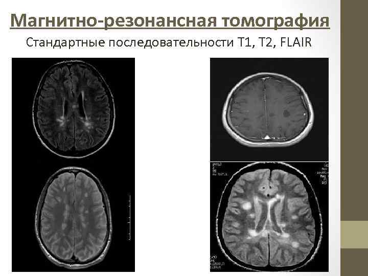 Магнитно-резонансная томография Стандартные последовательности Т 1, Т 2, FLAIR 