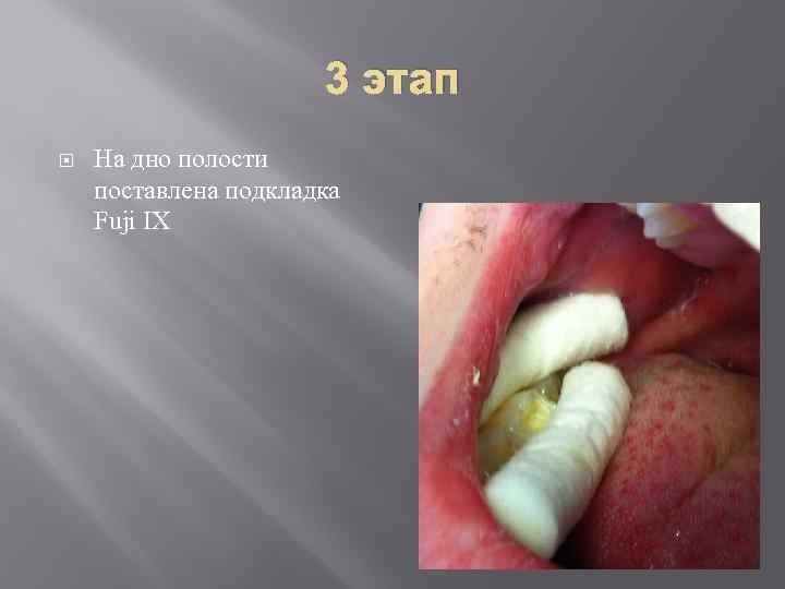 3 этап На дно полости поставлена подкладка Fuji IX 