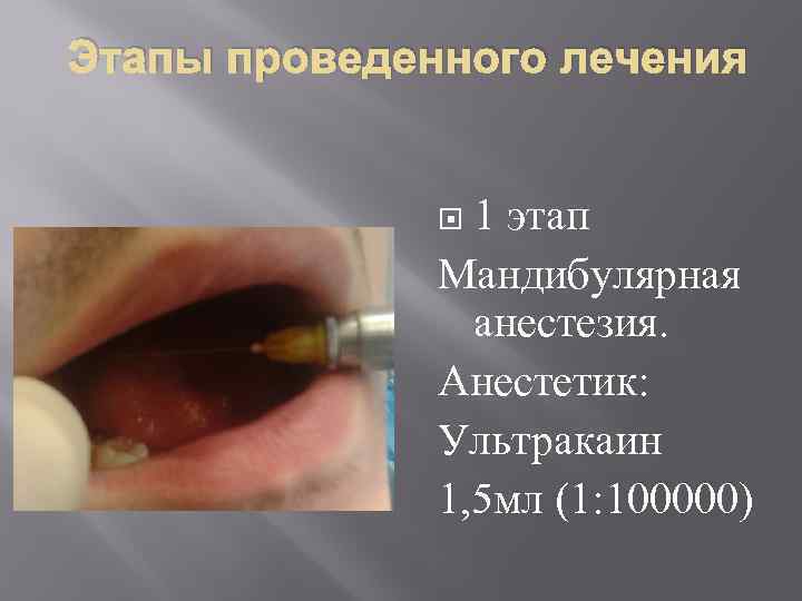 Этапы проведенного лечения 1 этап Мандибулярная анестезия. Анестетик: Ультракаин 1, 5 мл (1: 100000)