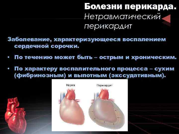 Болезни перикарда. Нетравматический перикардит Заболевание, характеризующееся воспалением сердечной сорочки. • По течению может быть