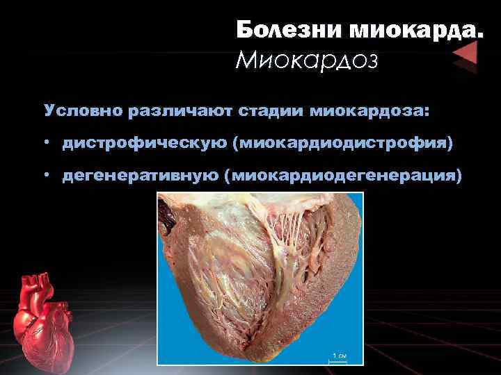 Болезни миокарда. Миокардоз Условно различают стадии миокардоза: • дистрофическую (миокардиодистрофия) • дегенеративную (миокардиодегенерация) 