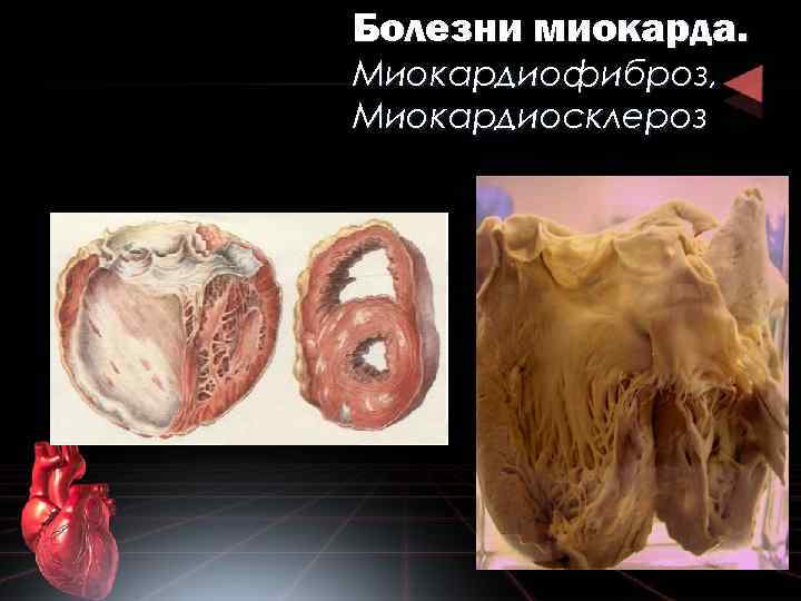 Болезни миокарда. Миокардиофиброз, Миокардиосклероз 