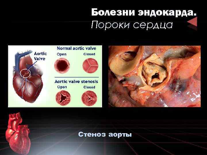 Болезни эндокарда. Пороки сердца Стеноз аорты 