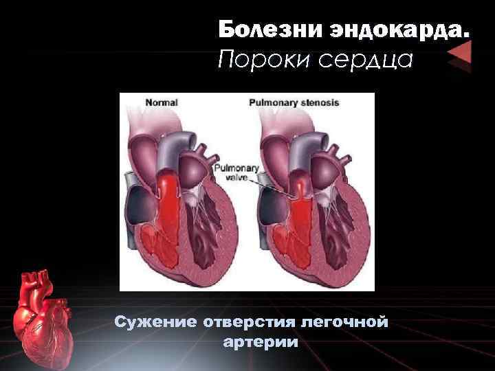 Болезни эндокарда. Пороки сердца Сужение отверстия легочной артерии 