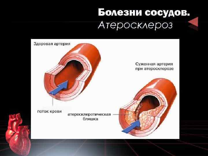 Болезни сосудов. Атеросклероз 