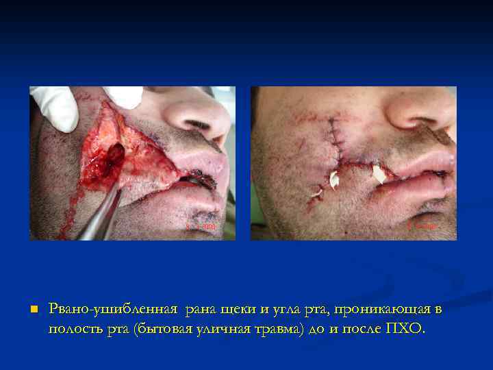 n Рвано-ушибленная рана щеки и угла рта, проникающая в полость рта (бытовая уличная травма)