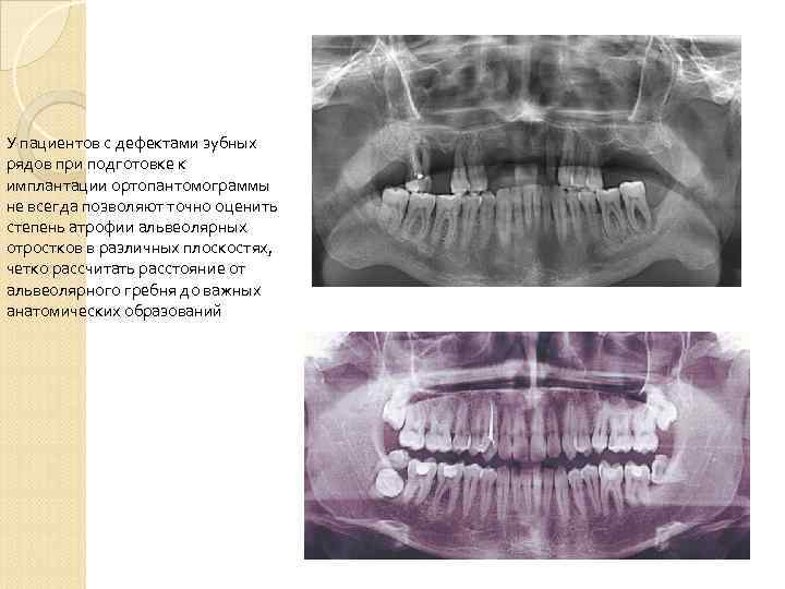 У пациентов с дефектами зубных рядов при подготовке к имплантации ортопантомограммы не всегда позволяют