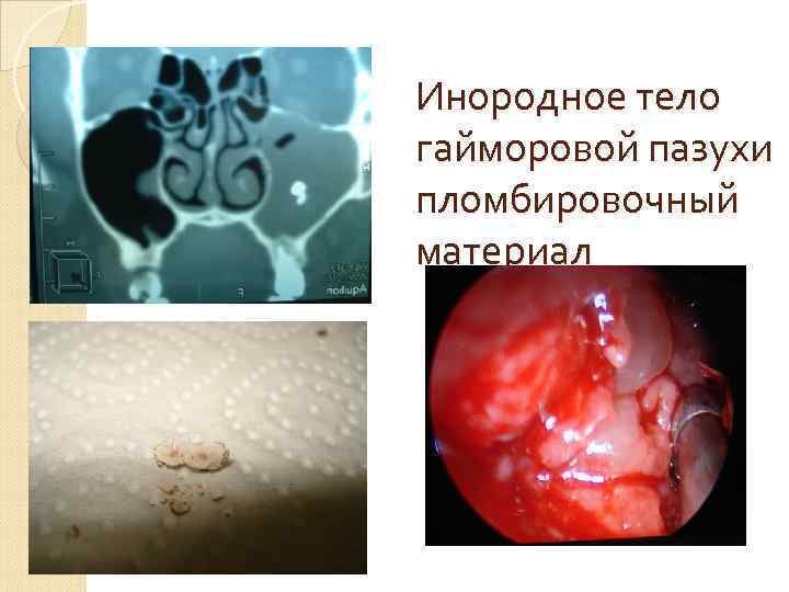 Инородное тело гайморовой пазухи пломбировочный материал 