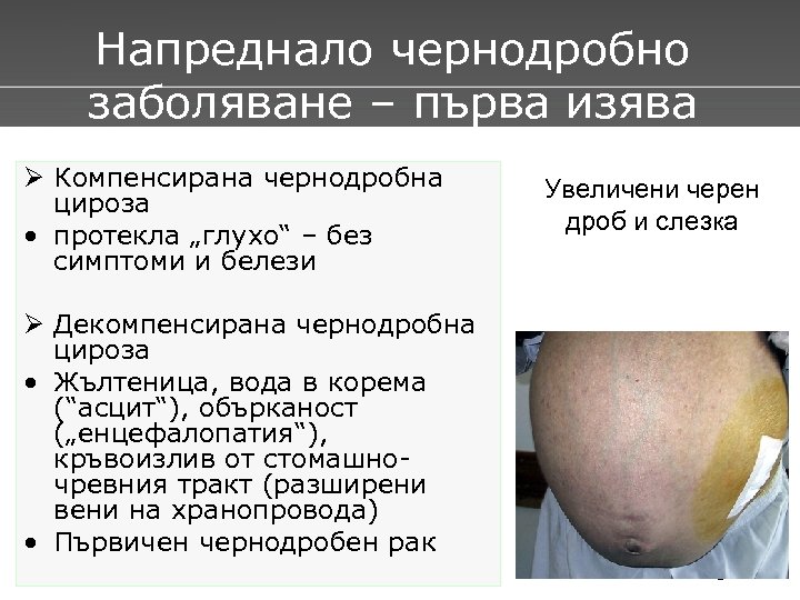 Напреднало чернодробно заболяване – първа изява Ø Компенсирана чернодробна цироза • протекла „глухо“ –