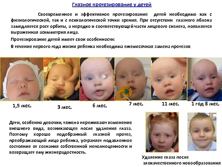 Глазное протезирование у детей Своевременное и эффективное протезирование детей необходимо как с физиологической, так