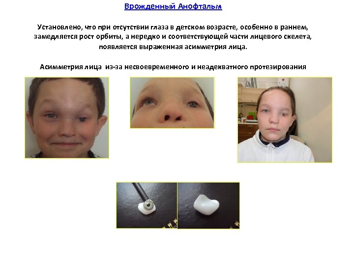 Врожденный Анофтальм Установлено, что при отсутствии глаза в детском возрасте, особенно в раннем, замедляется