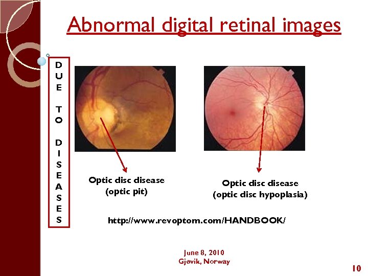 Abnormal digital retinal images D U E T O D I S E A