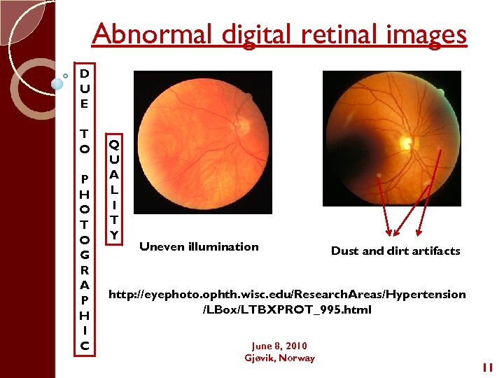 Abnormal digital retinal images D U E T O P H O T O