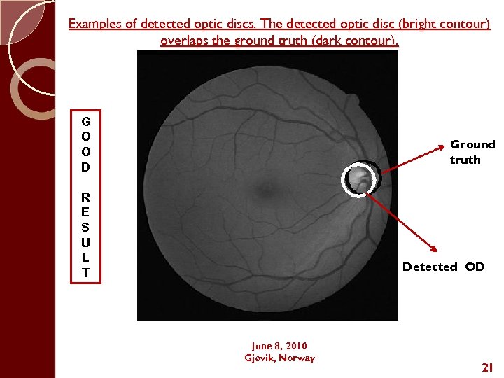 Examples of detected optic discs. The detected optic disc (bright contour) overlaps the ground