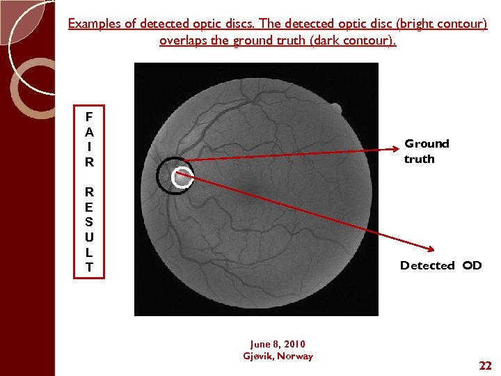 Examples of detected optic discs. The detected optic disc (bright contour) overlaps the ground