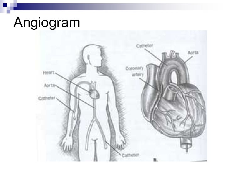 Angiogram 