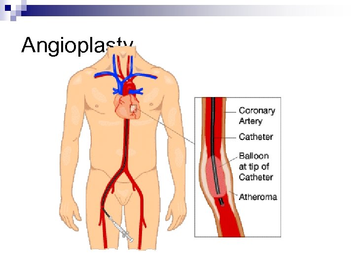 Angioplasty 