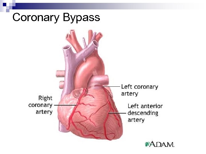 Coronary Bypass 