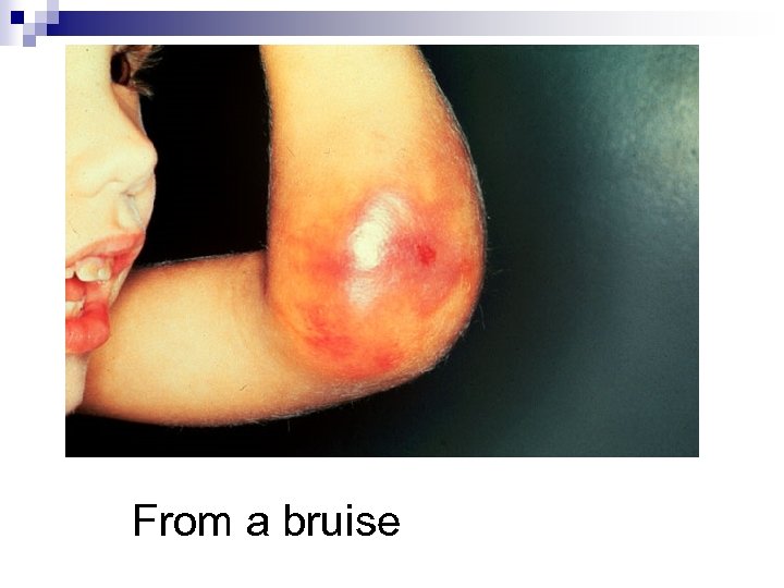 From a bruise 