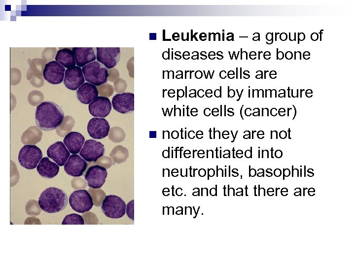 Leukemia – a group of diseases where bone marrow cells are replaced by immature