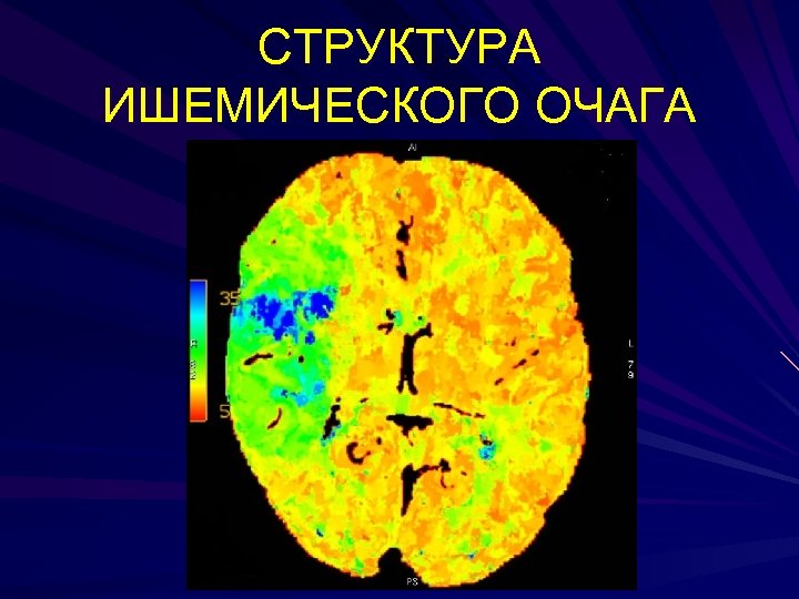 СТРУКТУРА ИШЕМИЧЕСКОГО ОЧАГА 