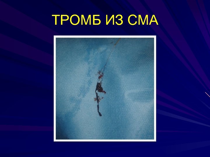 ТРОМБ ИЗ СМА 