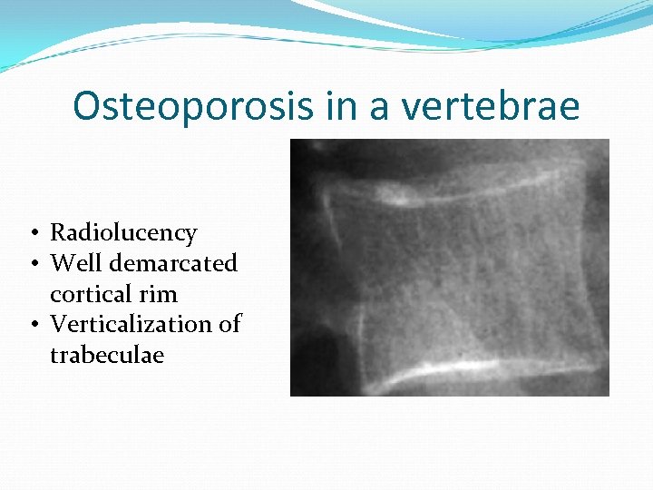 Osteoporosis in a vertebrae • Radiolucency • Well demarcated cortical rim • Verticalization of